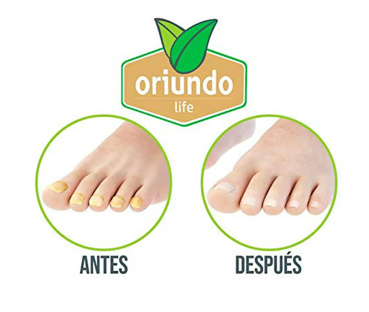 Oriundo Nail Fungus Treatment